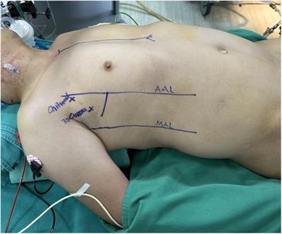 Totally 3D endoscopic aortic valve replacement: initial results and experience from a single center